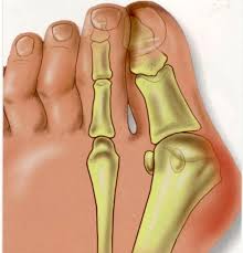 L’Hallux Abducto Valgus (HAV), communément appelé oignon, est une déviation du premier métatarse. Il est la résultante de facteurs génétiques (hérédité, laxité ligamentaire, etc.), biomécanique (arche du pied qui s’affaisse) et de chaussures inadéquates.