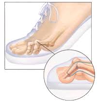 Nul besoin de porter des sandales à l’année longue! Nous avons la solution! Vous souffrez de cors douloureux au-dessus des orteils dès que vous mettez des souliers fermés ou de cors douloureux au bout des orteils? Une simple procédure pourrait grandement améliorer votre qualité de vie!